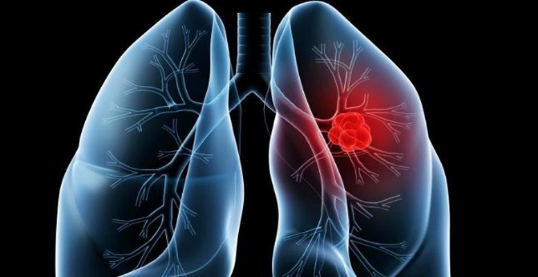 Ancaman Penyakit Kanker paru