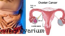 Faktor Penyebab Kanker Ovarium